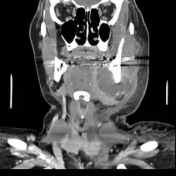 TCFC de face, corte coronal: observa-se lesão hipodensa importante no lado esquerdo da face associada a um dente posterior, infiltrando tecidos moles.