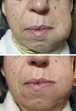 Abscesso dental afetando o lado esquerdo do rosto, com edema de face no segundo dia (primeira foto) e terceiro dia (segunda foto).