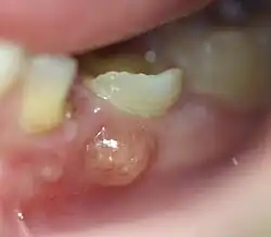 Abscesso envolvendo primeiro molar decíduo inferior. Observa-se extensa destruição coronária e a formação de parúlide (nódulo de coloração vermelho-amarelada com pus dentro) indicando a presença de um abscesso periapical.