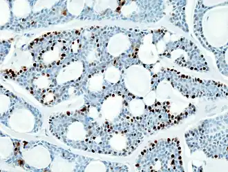 Imuno-histoquímica para S-100. Observa-se células marrons, que são positivas para S-100.