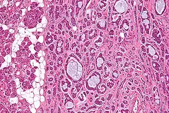 Carcinoma adenoide cístico (à direita da imagem): observa-se uma mistura de células mioepiteliais (predominantes, citoplasma escasso) e ductais. Tecido glandular normal à esquerda da imagem.
