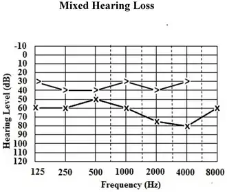 Exemplo de um exame de audiometria tonal limiar caracterizando uma perda auditiva mista na orelha esquerda (marcação em X é atribuida aos limiares de via área da orelha esquerda e a marcação > indica os limiares de via óssea).