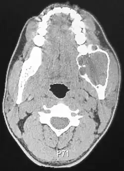 TC de paciente com ameloblastoma. Observa-se uma lesão hipodensa no ramo posterior da mandíbula no lado direito, delimitada por bordas hiperdensas.