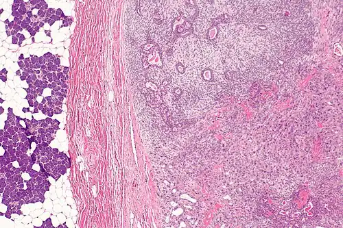 Carcinoma ex-adenoma pleomórfico (canto inferior direito). À esquerda se observa tecido glandular normal, e à direita o adenoma pleomórfico: o carcinoma estava contido dentro do componente benigno, e é caracterizado por intensa proliferação celular.