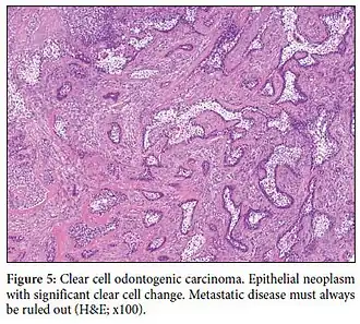 Carcinoma odontogênico de células claras. Observa-se transformação epitelial em células claras. HE, aumento x100.