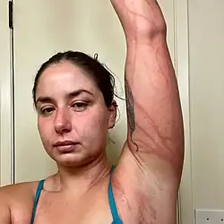 Bengisu Avcı&nbsp;[en], uma nadadora turca, em maio de 2024 após entrar em contato com águas-vivas enquanto tentava atravessar o Canal de Molokaʻi no Havaí.