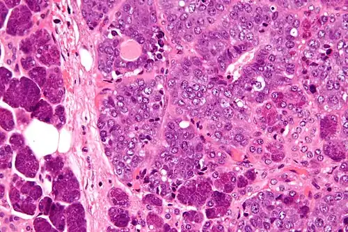 Carcinoma epitelial-mioepitelial (à direita da imagem). Observa-se morfologia tubular e a presença de células epiteliais e mioepiteliais.