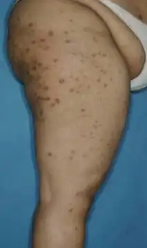 Escoriação em Ponto