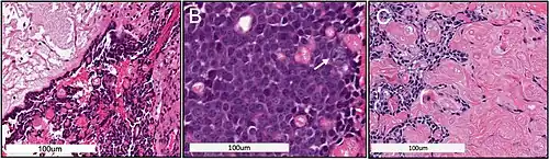 Biópsia incisional, em HE