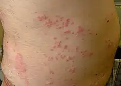 Dermatite por contato com água-viva.