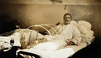 Soldado ferido em Verdun e amputado da perna no hospital militar em Ris-Orangis. 1916.