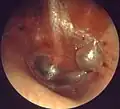 Otite média aguda - Myringitis bullosa