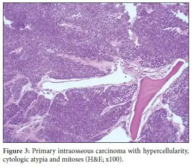 Carcinoma intraósseo primário. Nota-se hipercelularidade, atipia celular e mitoses. (HE, aumento de x100)