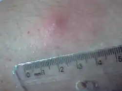 Reação intradérmica de Montenegro. Resultado reagente (após 72 Horas da inoculação).