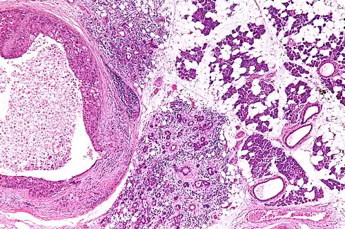 Carcinoma do ducto salivar (à esquerda da imagem). As células se assemelham ao carcinoma ductal de mama, e há presença de necrose. À direita, tecido glandular normal.