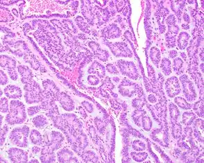 Coloração de HE (hematoxilina-eosina) de adenoma canalicular mostrando canalículos compostos por células neoplásicas epiteliais cuboidais.