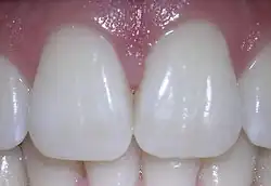 Incisivo central superior