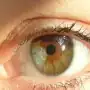 Heterocromia setorial