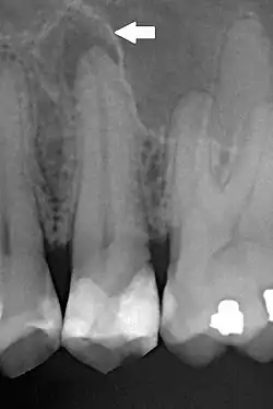 Radiografia periapical de segundo pré-molar superior esquerdo afetado por PA crônica. Observa-se extensa restauração no dente afetado, e rarefação óssea difusa associada ao periápice, com perda de continuidade da lâmina dura.