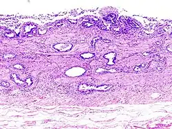 Câncer biliar descoberto após uma colecistectomia