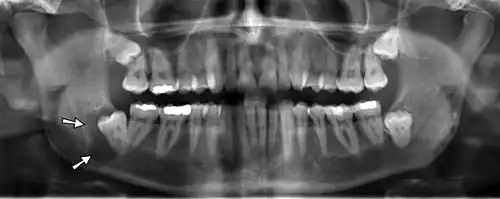 Radiografia panorâmica mostrando terceiro molar inferior direito (siso) impactado com cisto dentígero (seta).