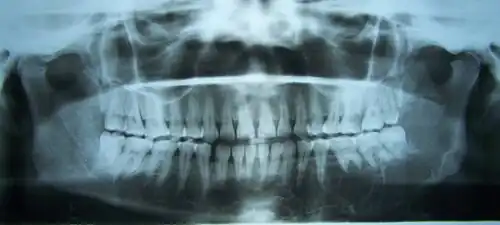 Radiografia panorâmica, mostrando lesão radiolúcida multilocular em mandíbula esquerda, estendendo-se da região subcondilar aos pré-molares.
