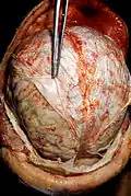 Autopsy photo from the CDC: The white "sheet" being held by the forceps is the dura mater.
