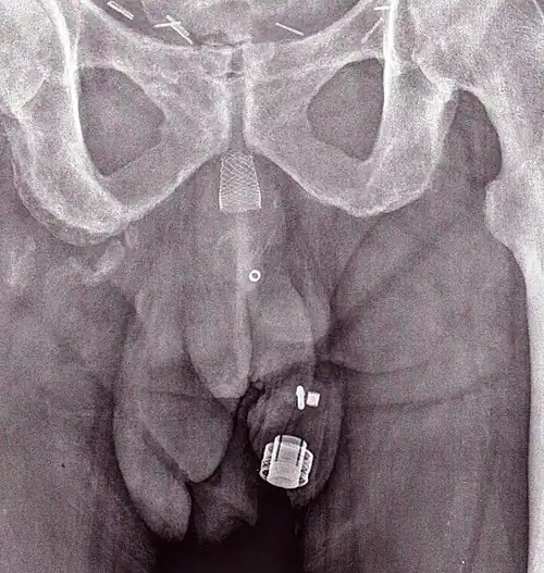 Uma imagem de raio X de um ZSI 375 implantado. O aparelho está desativado - a mole está comprimida abaixo do topo do cilinder. O paciente está continente.