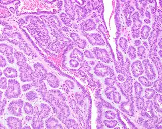Adenoma canalicular: observa-se canais ou canalículos com células epiteliais neoplásicas cuboidais baixas. Coloração de hematoxilina-eosina.