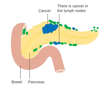Estágio N1: Cancro pancreático nos gânglios linfáticos próximos