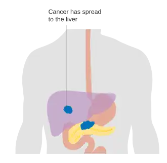 Estágio M1: Cancro pancreático metastatizado
