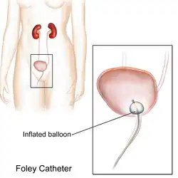 Cateter Foley/Permanente