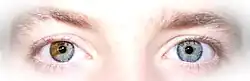 Heterocromia setorial