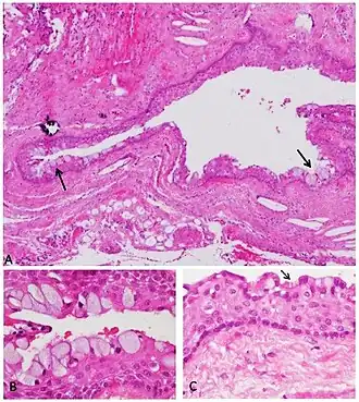 Cisto radicular. A) Fragmentos da parede cística mostrando metaplasia em células mucinosas; B) Magnificação das células mucinosas; C) Células ciliadas, e abaixo uma cápsula fibrosa contendo cristais de colesterol e células inflamatórias. Coloração HE, aumento de 100x.