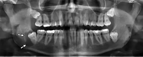 Radiografia panorâmica mostrando terceiro molar inferior direito (siso) impactado com cisto dentígero (seta).