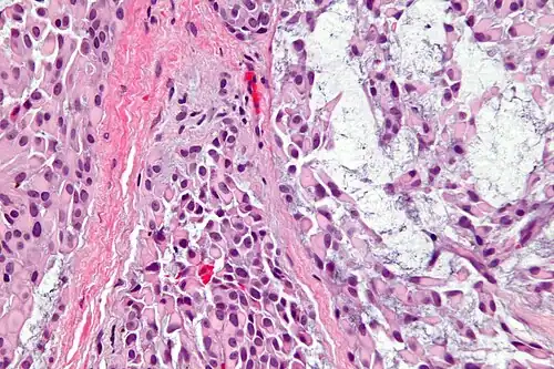 Mioepitelioma: observa-se células tumorais de aspecto plasmocitoide.