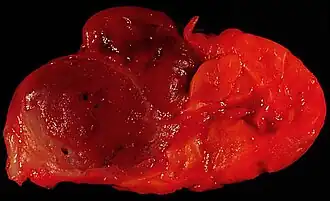 Oncocitoma em glândula submandibular. À esquerda, observa-se a massa tumoral de cor escurecida, característica do oncocitoma, comparada à coloração mais clara do tecido glandular normal à direita.