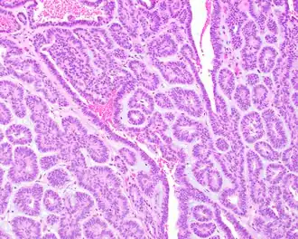 Adenoma canalicular: observa-se canais ou canalículos com células epiteliais neoplásicas cuboidais baixas. Coloração de hematoxilina-eosina.