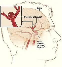 Aneurisma cerebral