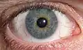 Heterocromia central
