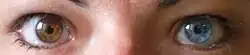 Heterocromia sectorial.