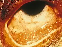 Conjuntivite causada pela clamídia